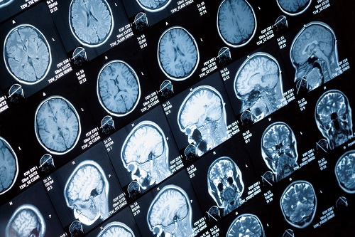 Work injury brain scans