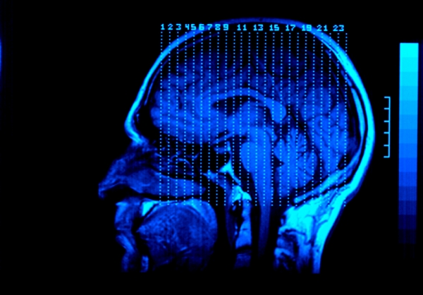 The Most Common Type of Brain Injury in Auto Accidents