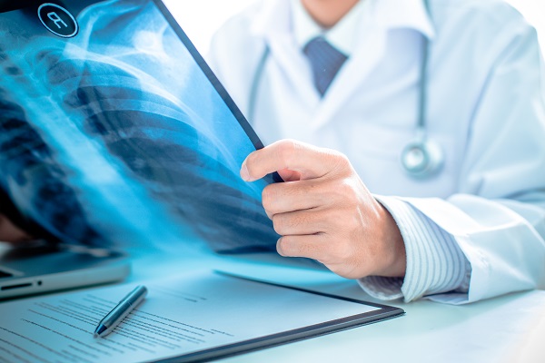 Doctor reviewing an x-ray of his patient's chest cavity and rib cage