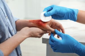 Doctor covering patients burn of hand with cotton pad indoors